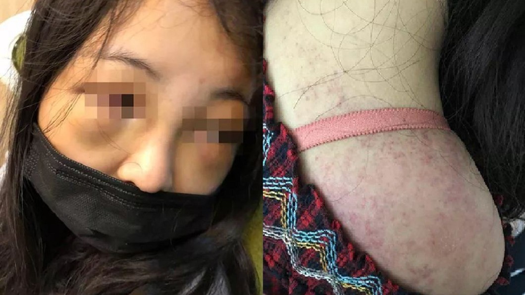 打呼太大聲　少女遭室友圍毆「右耳失聰」