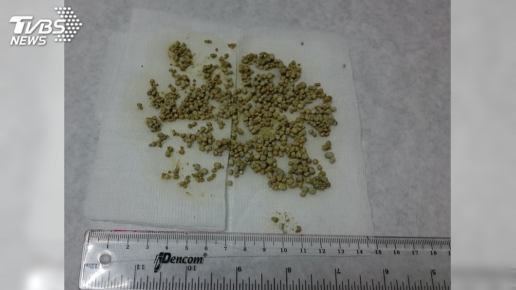 8旬老翁排尿困難 膀胱清出300顆結石