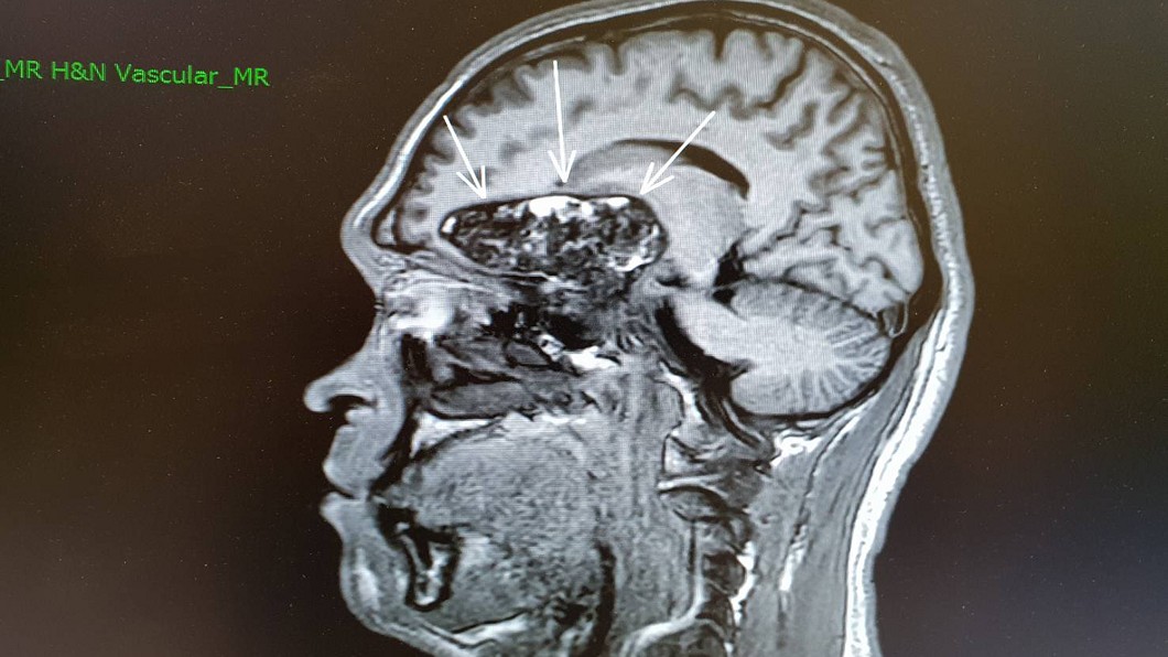 老是聞到腐臭味 腦部腫瘤搞鬼