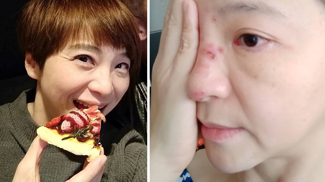染「皮蛇」險失明 知名主播毀容照曝光