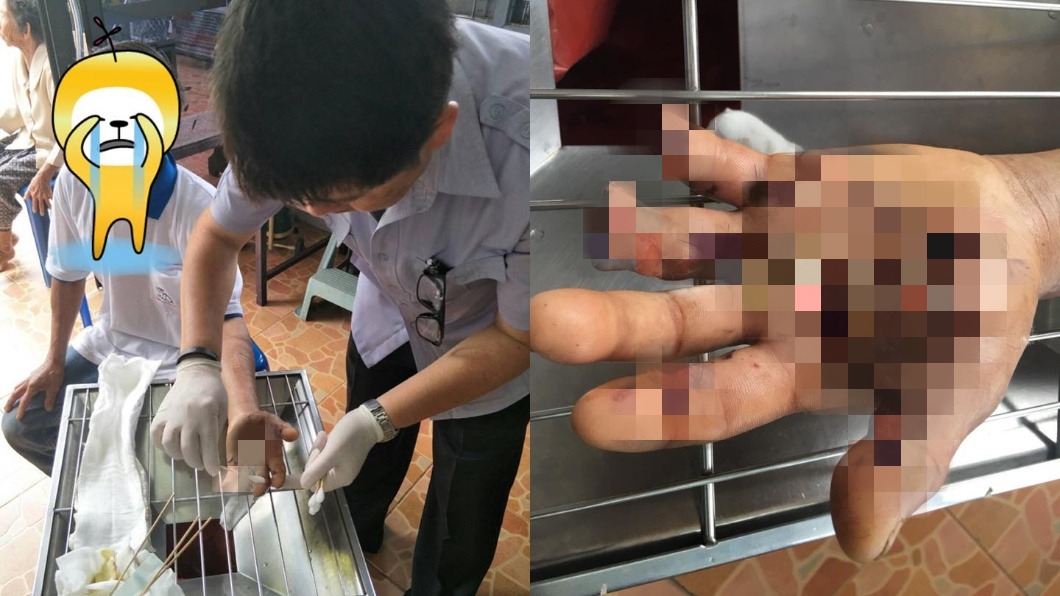 悚!充電時接電話手機竟爆炸 男手指被炸斷