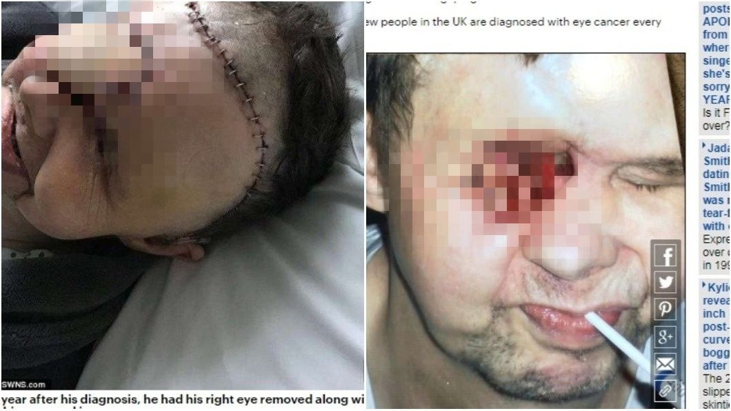 眼癌誤診偏頭痛!他術後慘變「獨眼男」 孫子看到都害怕