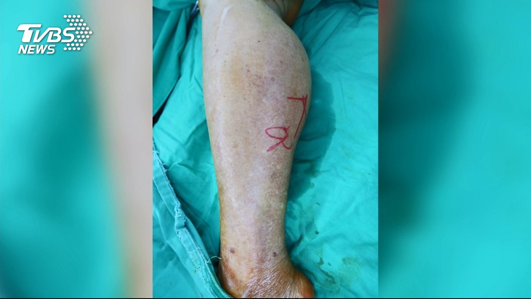 推拿愈痛愈有效? 錯!60歲男子血腫險截肢