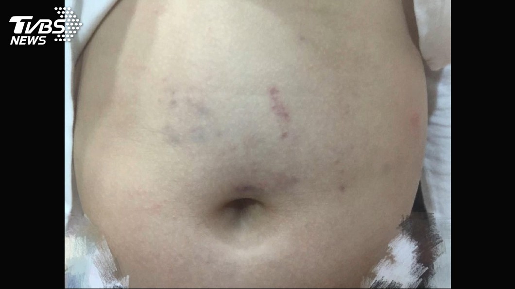 「妳打我孩子！」6歲童遭師拍打　腹部瘀傷