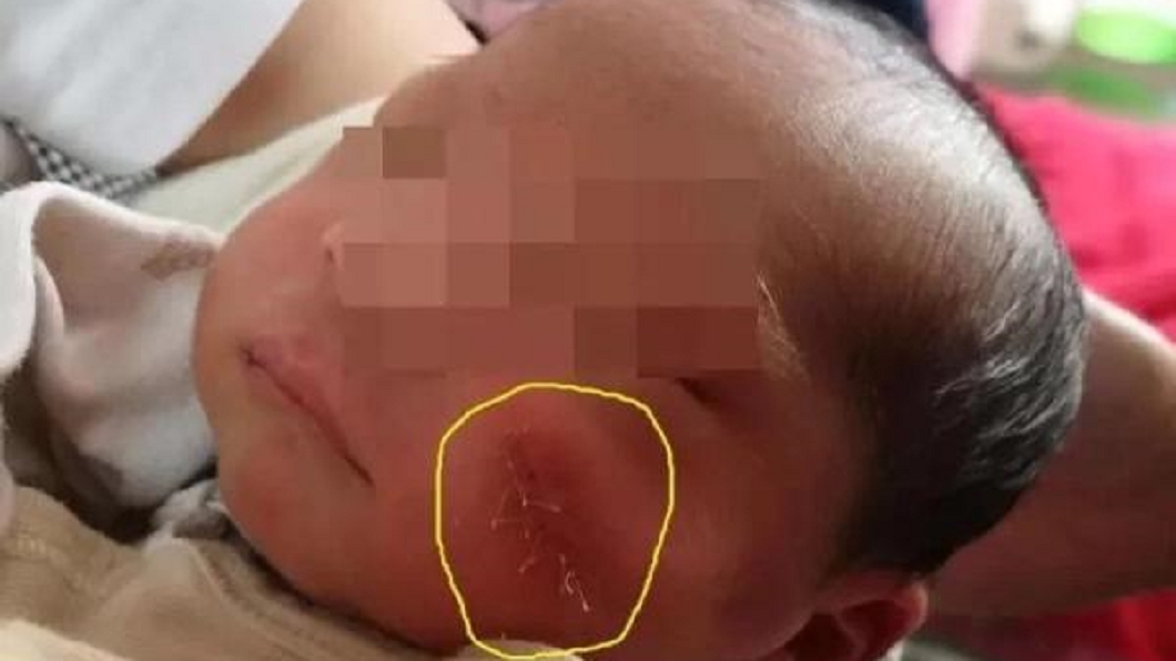 女嬰出生就毀容 剖腹產劃傷寶寶左臉醫師竟裝死