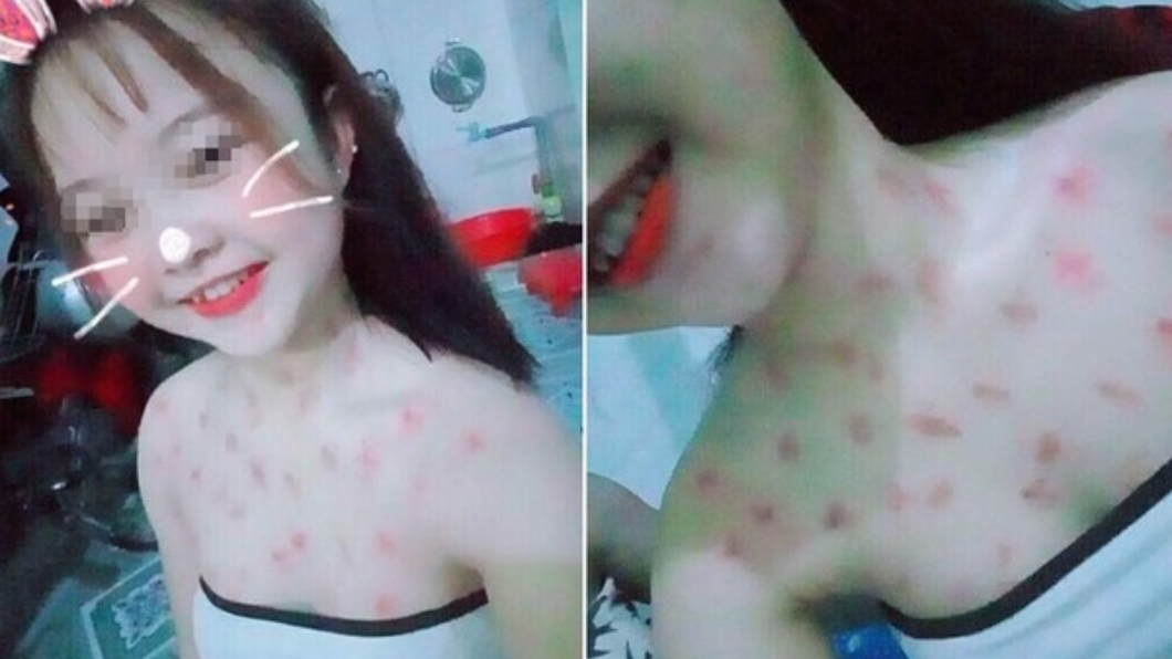 至少50個!國中妹得意曬戰績 白皙皮膚變「草莓園」