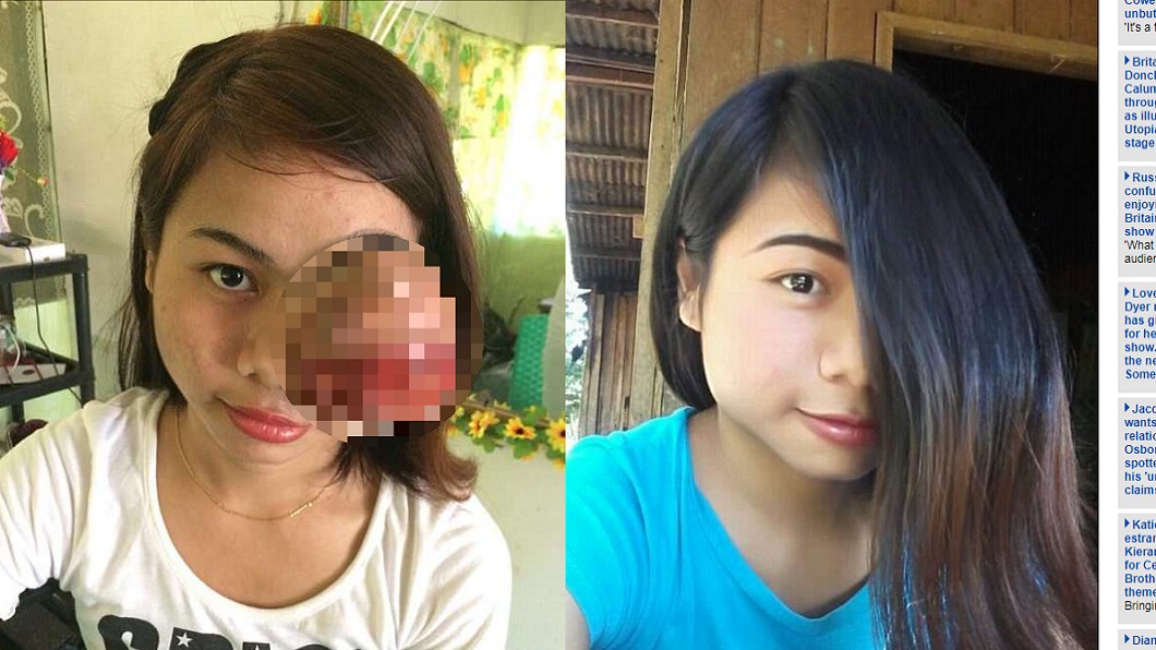 慎入!少女長髮遮「左眼巨瘤」 淚嘆:好想談戀愛…