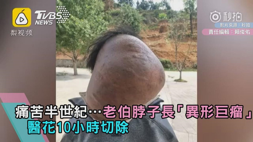 痛苦半世紀…老伯脖子長「異形巨瘤」 醫花10小時切除