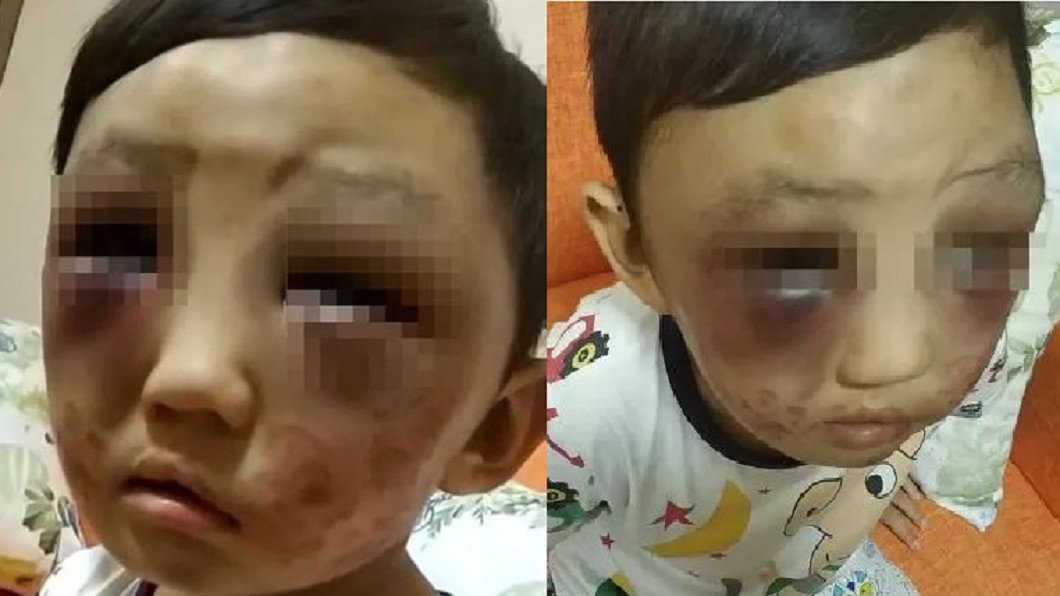 4歲童遭毒打「雙眼瘀青」　狠母嗆：打小孩天經地義