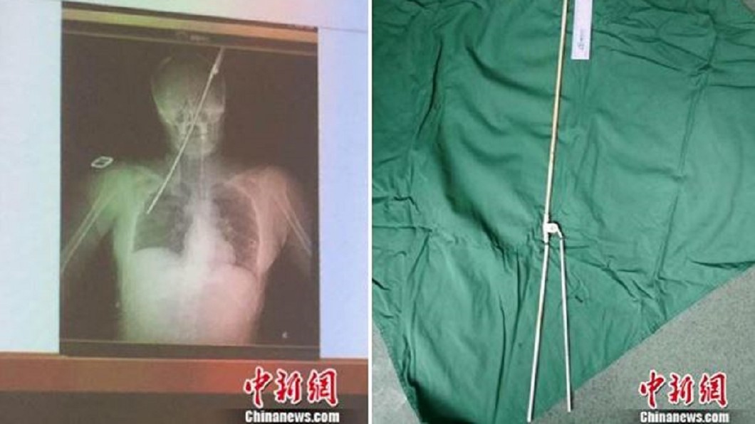 怪風吹襲！40cm傘骨直插女左眼　貫穿鼻腔「頂到肺」