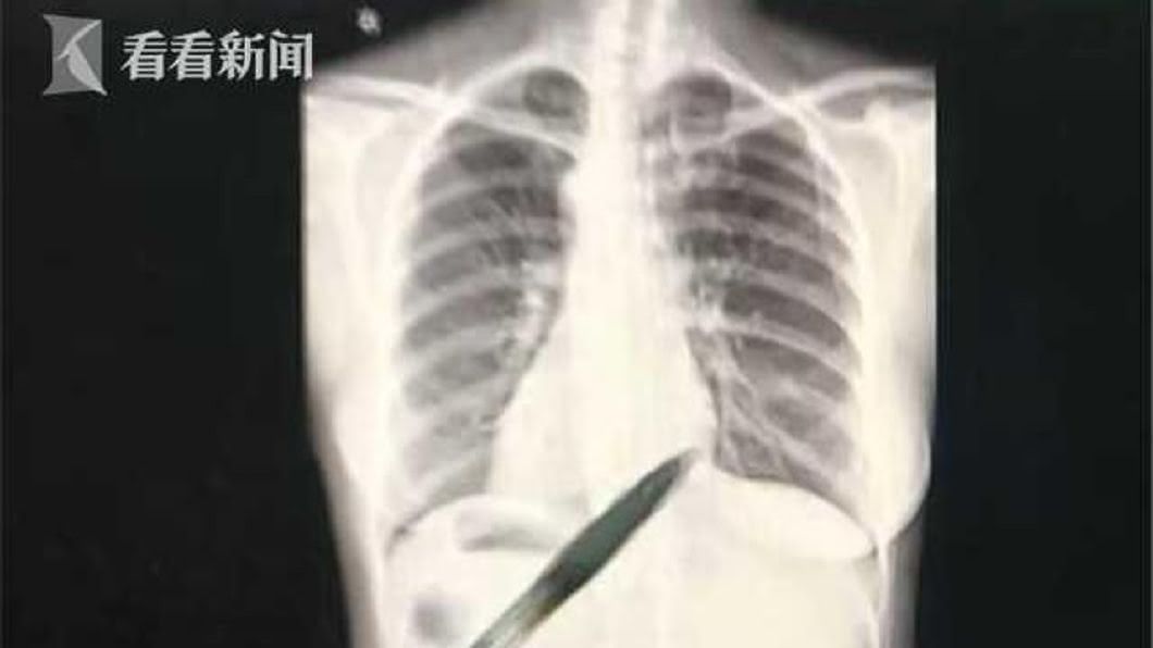 百萬分之一機率!罕見「鏡面人」 她五臟六腑全長反
