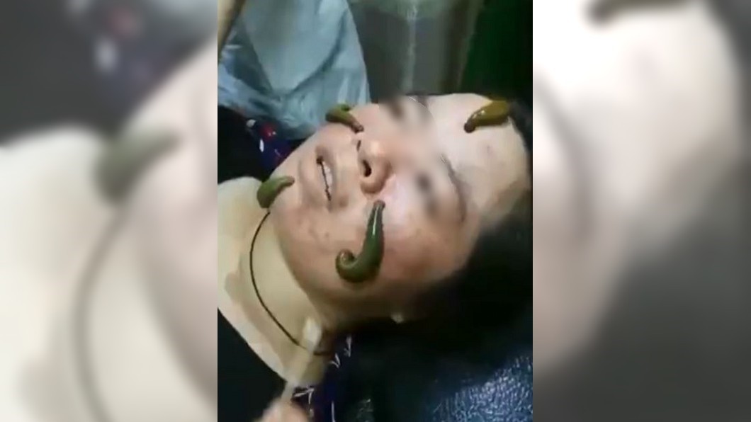 用水蛭吸痘痘?4條爬臉蠕動 美容師:你看斑都沒了!