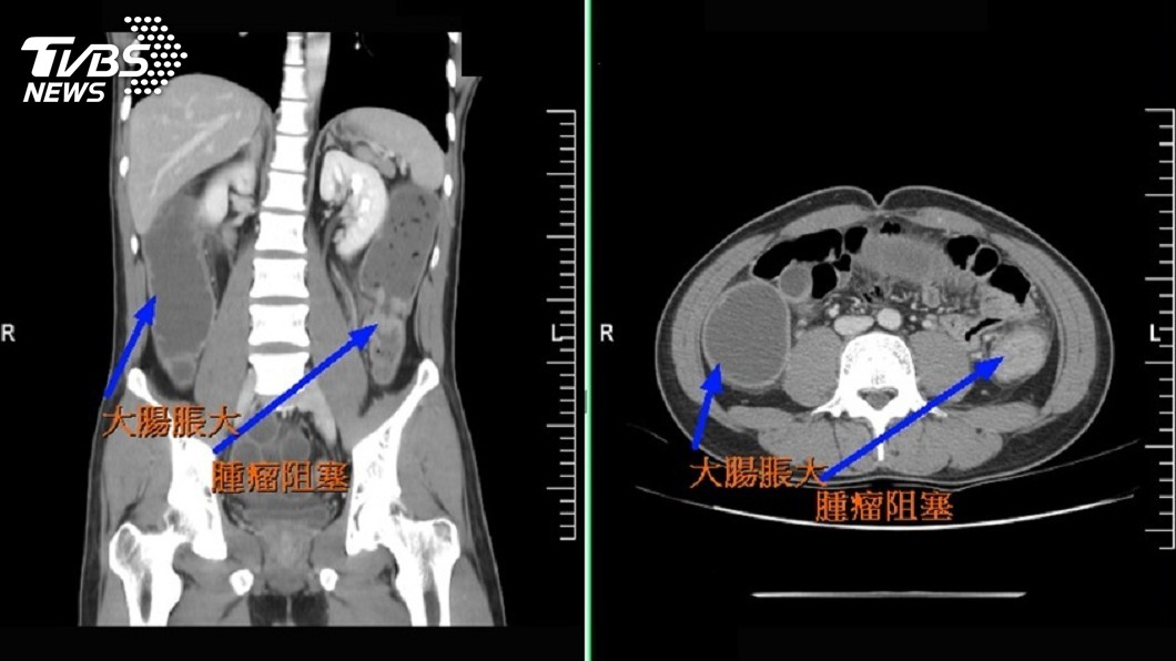 大腸癌年輕化！　28歲男不菸酒重養生也罹病