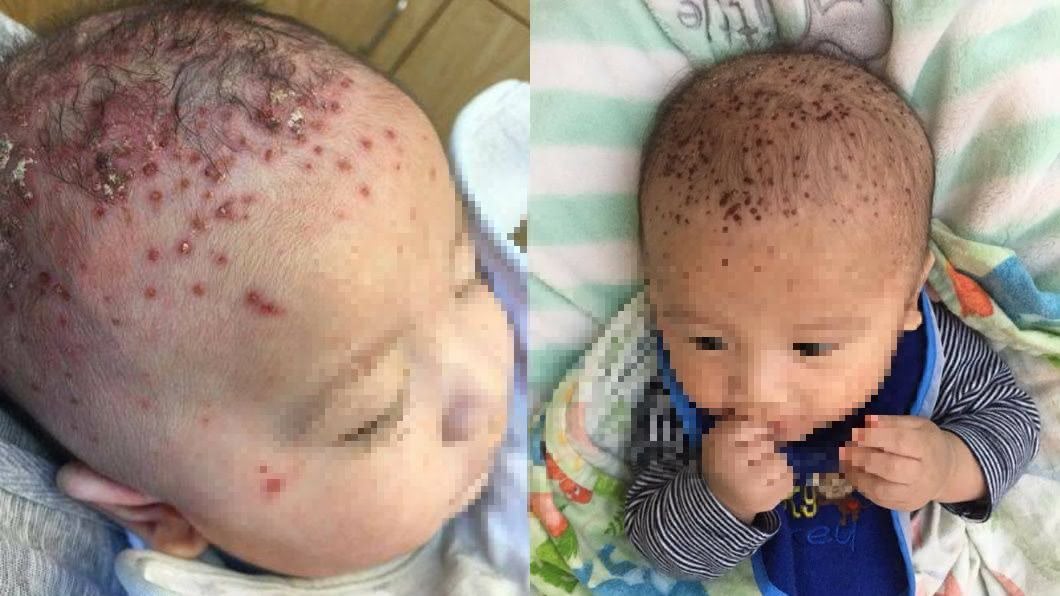 滿頭流膿疱疹！長輩「愛的親親」　害嬰兒感染病毒住院