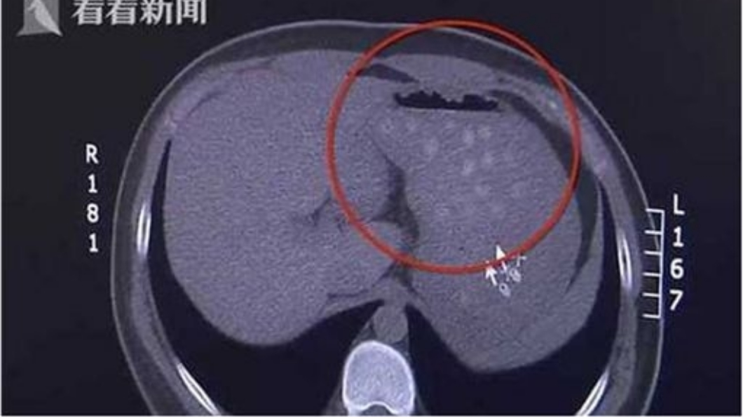 連喝2杯珍奶 他腹痛就醫…驚見珍珠「堆成山」