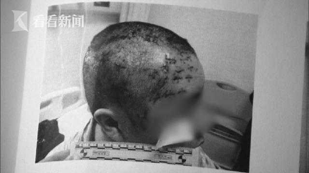 女遭男友狠砍60刀險死 醒來後原諒他還要相守到老