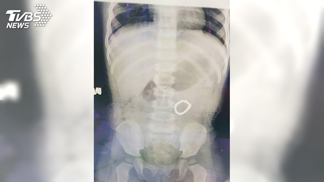 女童吞異物卡腹部　手術取出18顆磁力球