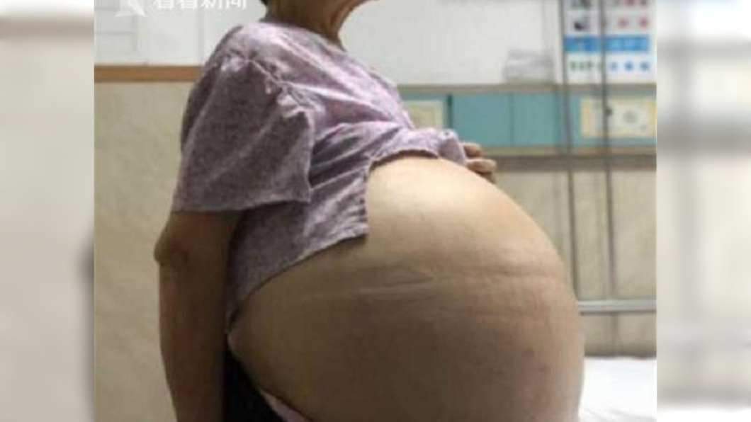 老婦4肢被吸乾！肚卻大如瑜伽球　 抽33公升囊液保命
