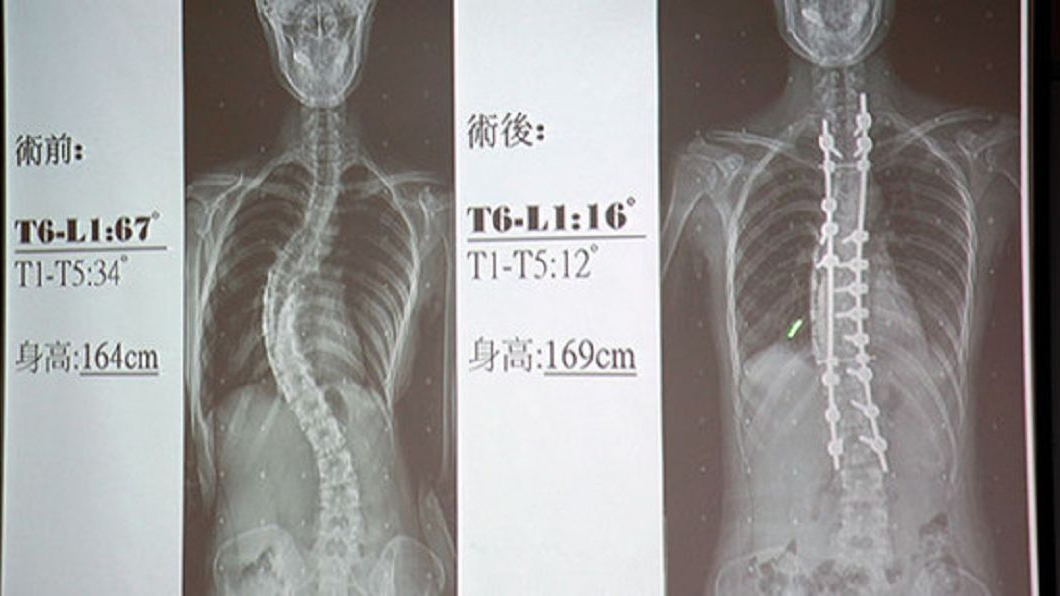 24歲女脊椎彎67度 手術矯正瞬間「長高5公分」