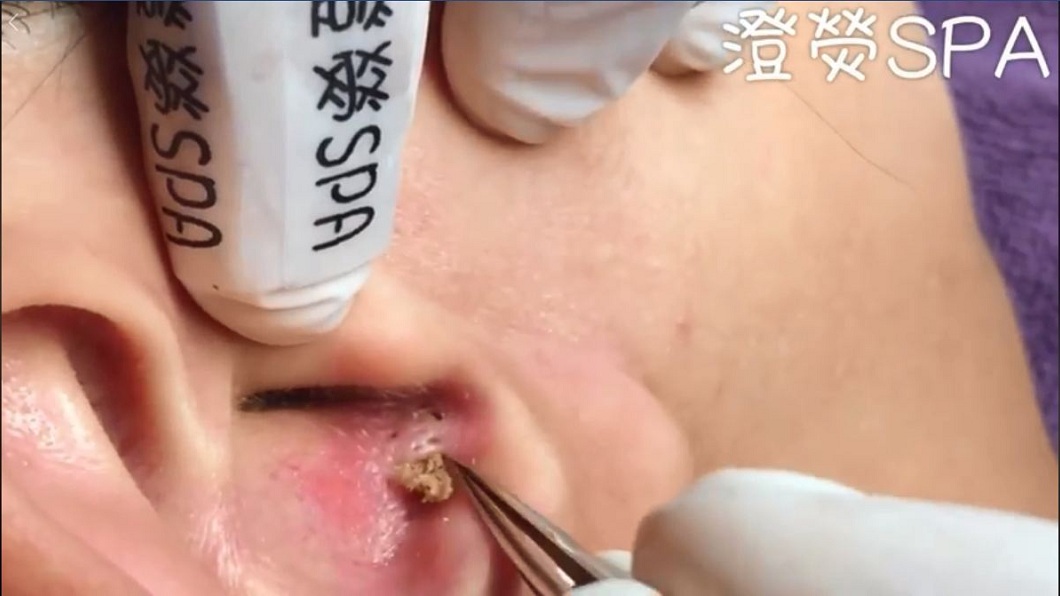這次是一名女客人的左耳出現黑頭粉刺。(圖／翻攝自「澄熒SPA」臉書粉絲團)