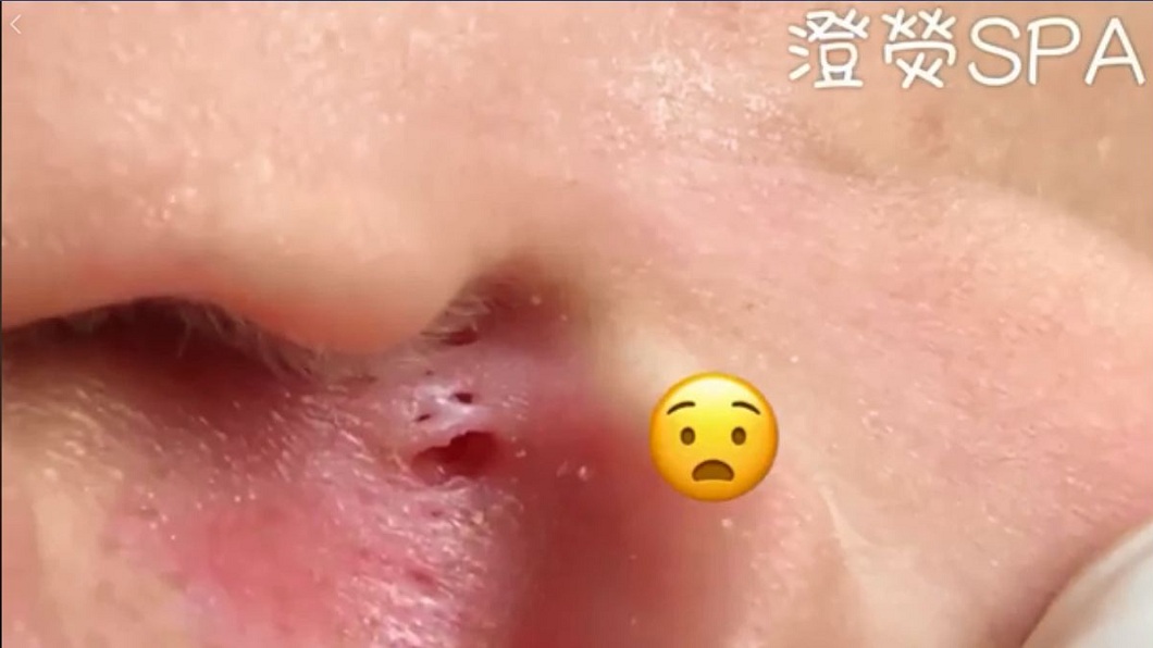黑頭粉刺清除後，網友們直呼好紓壓。(圖／翻攝自「澄熒SPA」臉書粉絲團)