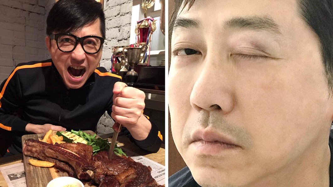 庾澄慶曝被家暴 右眼瘀青腫脹