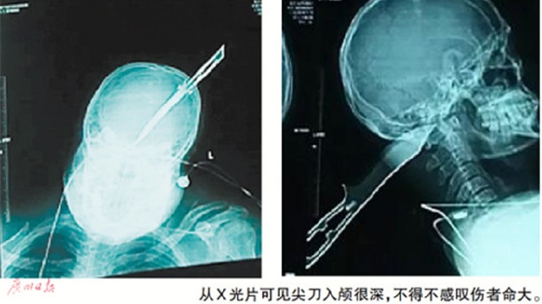 他遭利刃刺頭8公分　腦袋插刀還冷靜騎車去報警
