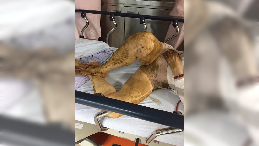 獨居老婦倒臥家中飄糞味 護理師無怨言替她沖澡換裝