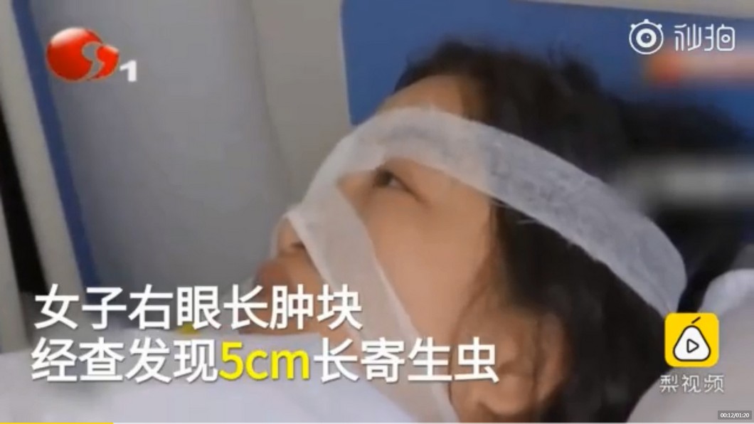 女愛吃野味「右眼長腫塊」 手術拉出5公分蠕動活蟲