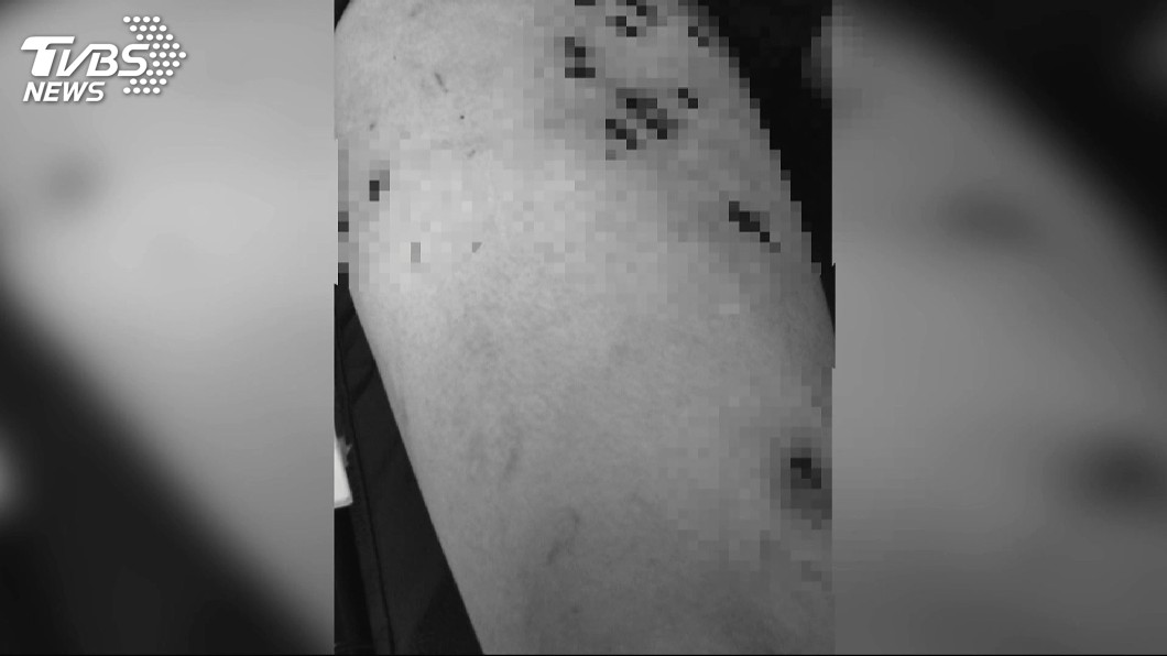 疑遭酷刑凌虐… 男子下半身處處燒灼傷口