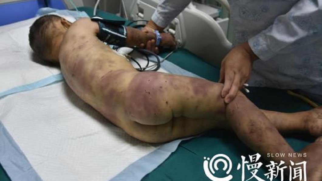 疑婆媳不和...阿嬤爆打5歲孫出氣 全身瘀青陷昏迷