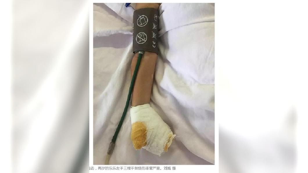金屬飯匙插延長線插孔…2歲童電飛　左手壞死腦受損