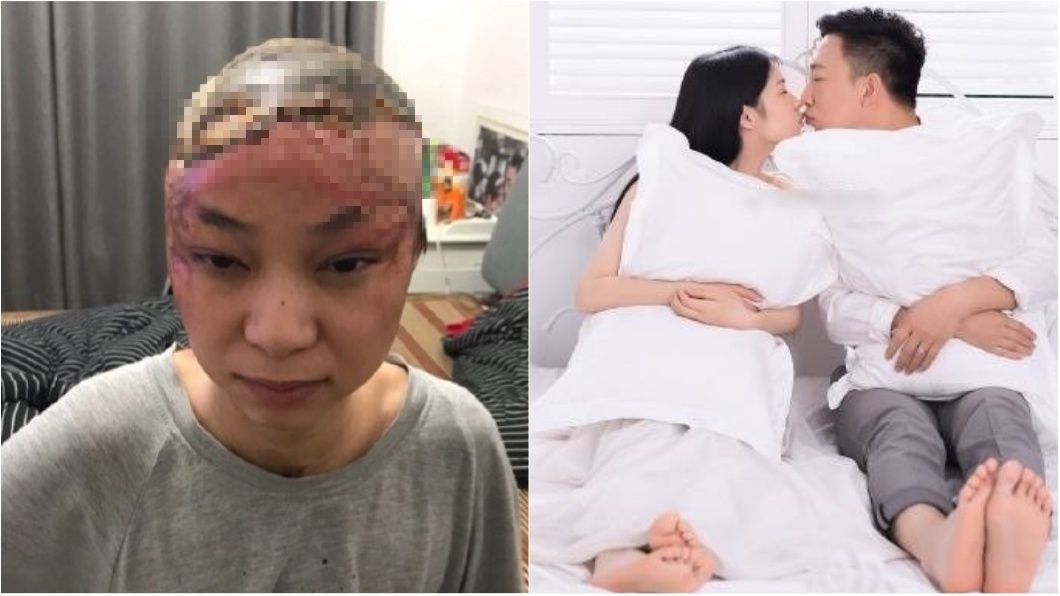 元配心冷自焚「頭顱見骨」 丈夫竟牽學生妹甜蜜拍婚紗