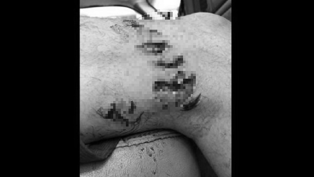 海邊游泳大腿被咬出「6深洞」 衰男:牠想吃我