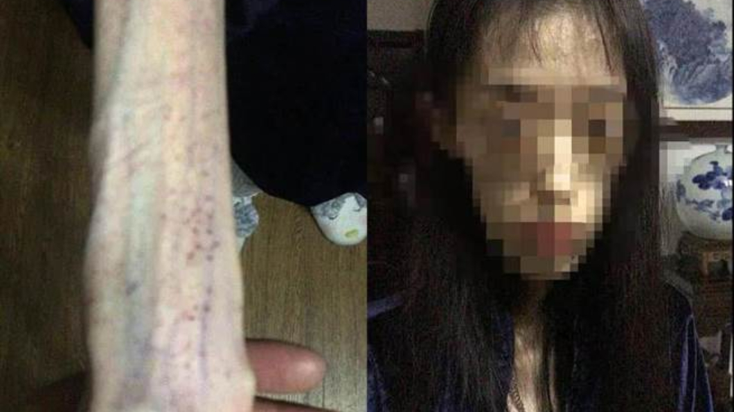 她「自殺式减肥」剩25公斤　大腦退化如60歲還失憶