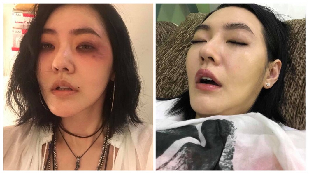 小S臉上「莫名」長出這特徵 網憂出狀況急喊:快就診!