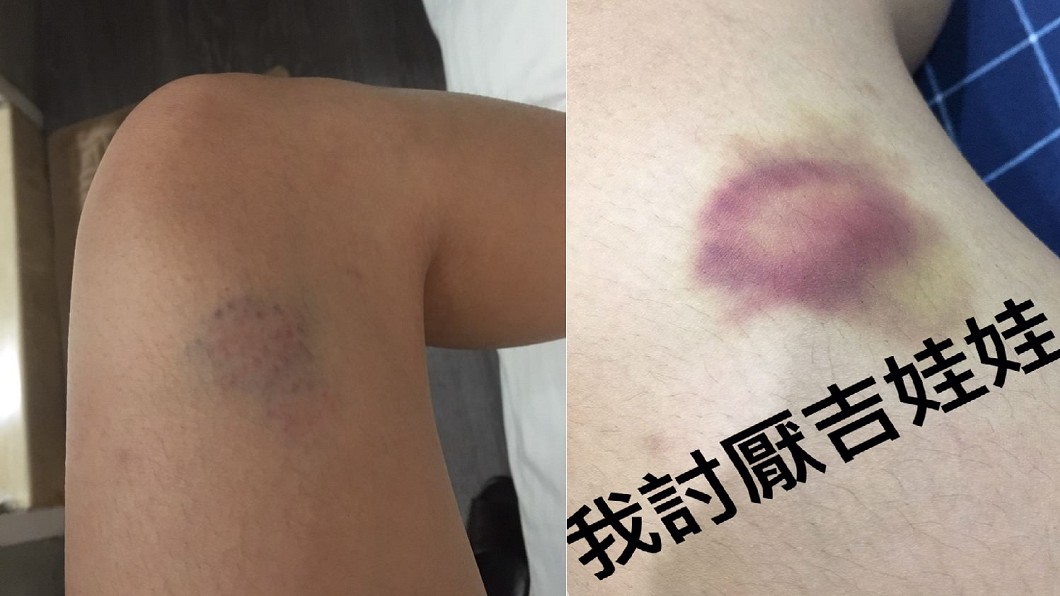 女友借廁所被吉娃娃踢一腳 3天後…浮出紅紫瘀青