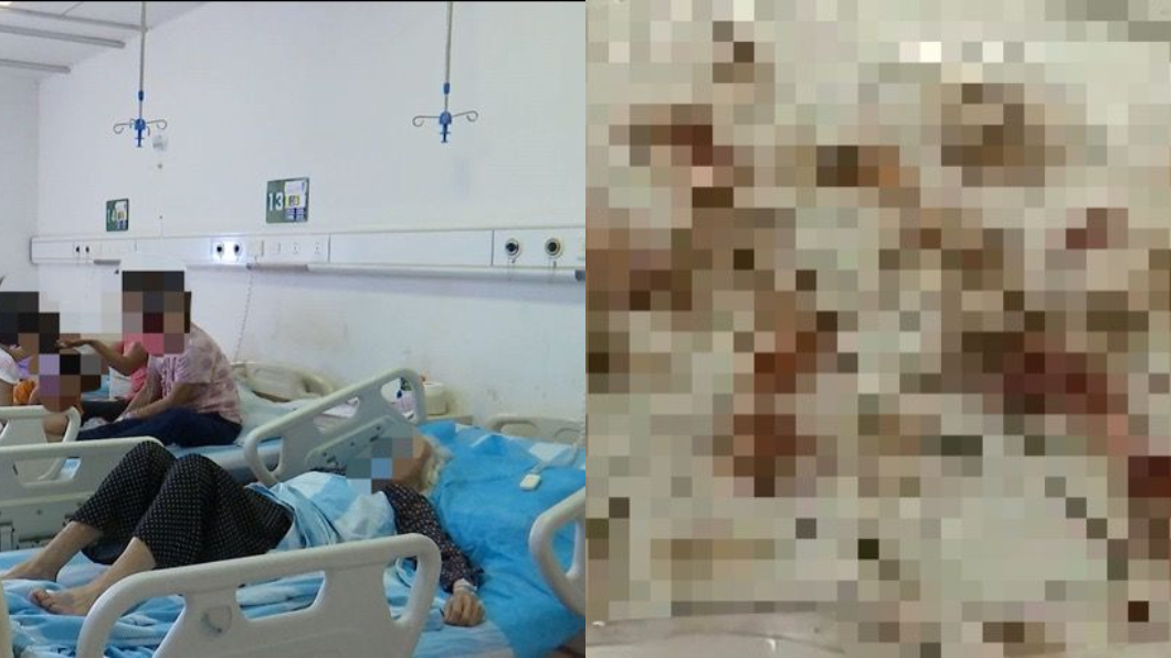 9旬老婦臉部潰爛不理 就醫後夾出160條活蛆