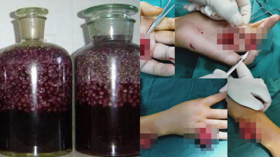 酒會爆炸?女心血來潮自釀葡萄酒 雙手慘遭炸傷送醫
