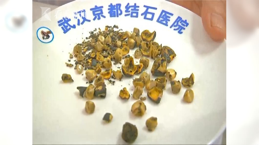 婦人愛吃菜不吃肉 竟長55顆「爆米花」膽結石
