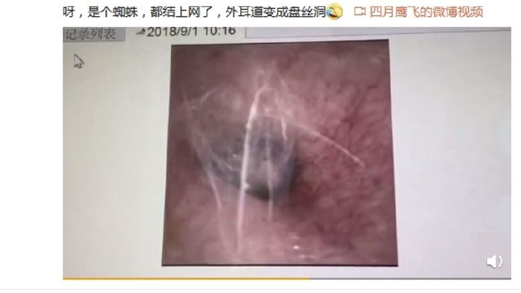 蜘蛛鑽人耳還結網 不時傳來「敲鼓聲」他快瘋了