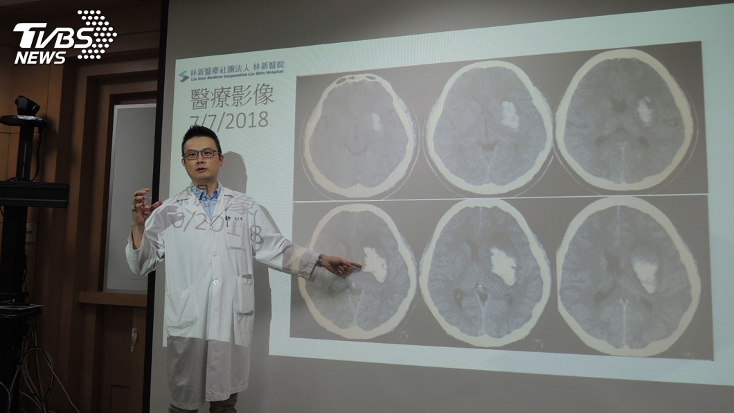 年輕人莫忽視！36歲男子突跌倒失語　腦出血中風
