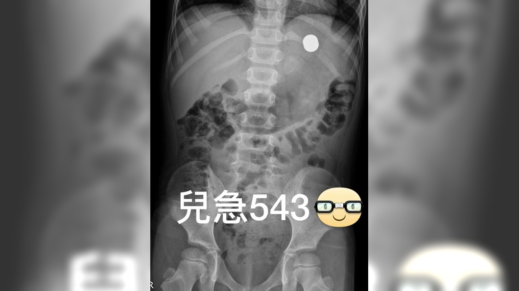 6歲童腹部吸磁鐵還以為萬磁王 真相讓爸媽又氣又笑