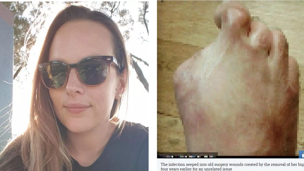 泰國做溫泉魚療 女腳趾骨被「細菌侵蝕」全截肢