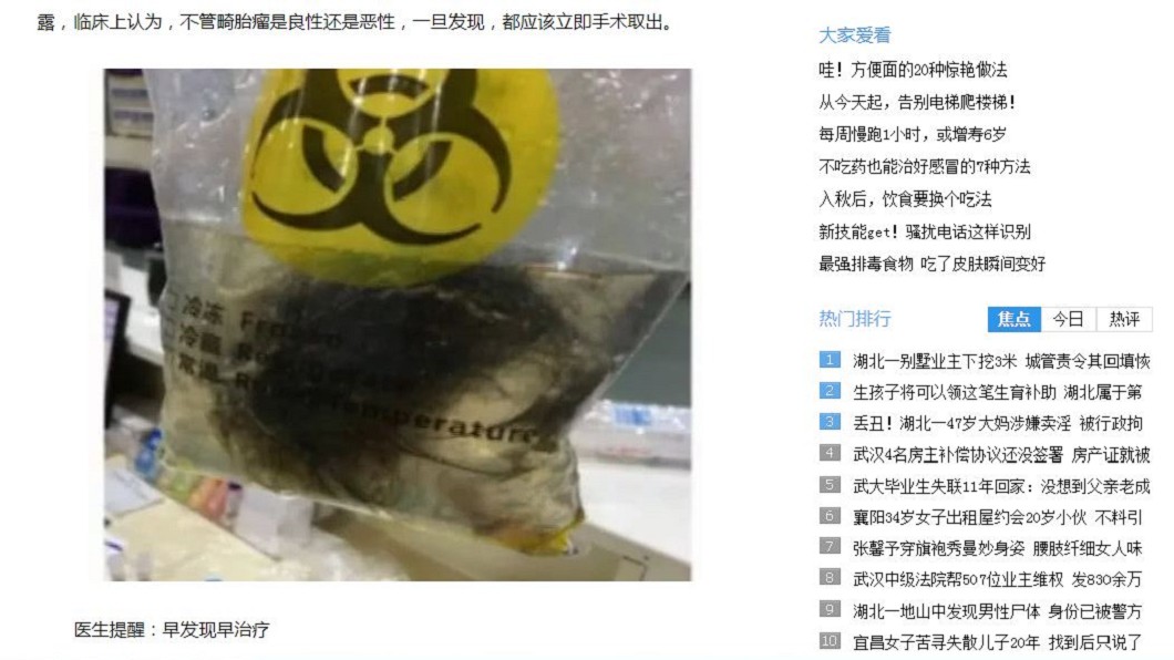 女卵巢拉出頭髮與骨頭 原來是自己「兄弟姊妹」