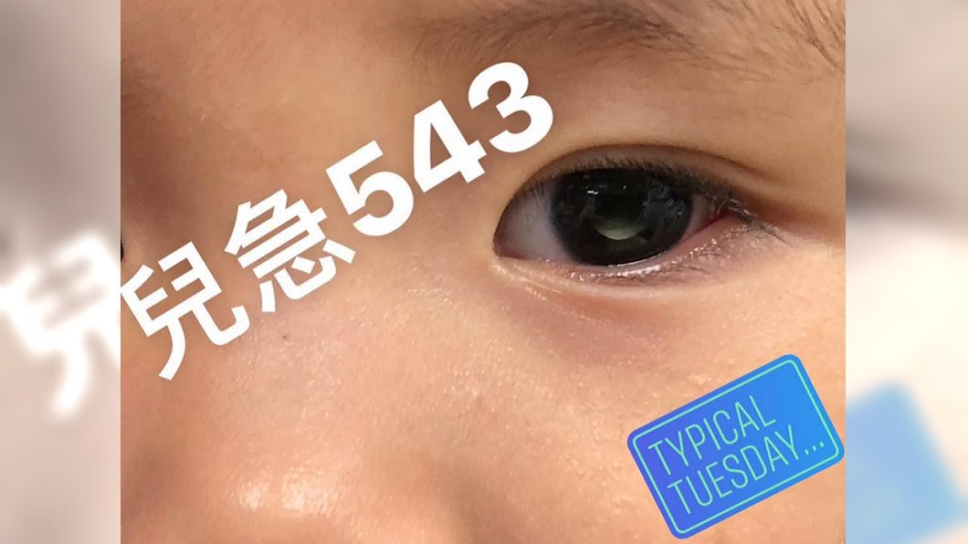 3歲女童眼中有白點…以為眼睛髒　檢查發現是眼癌