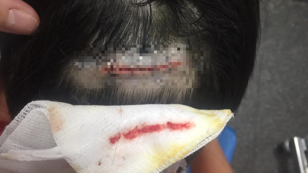 公園護墊磨損露金屬 男童摔破頭「7公分傷口見頭骨」