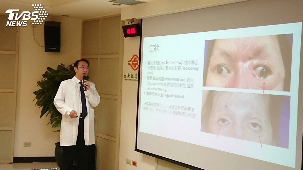火吻後眼睛閉不緊像翻白眼　重建手術助她找回自信