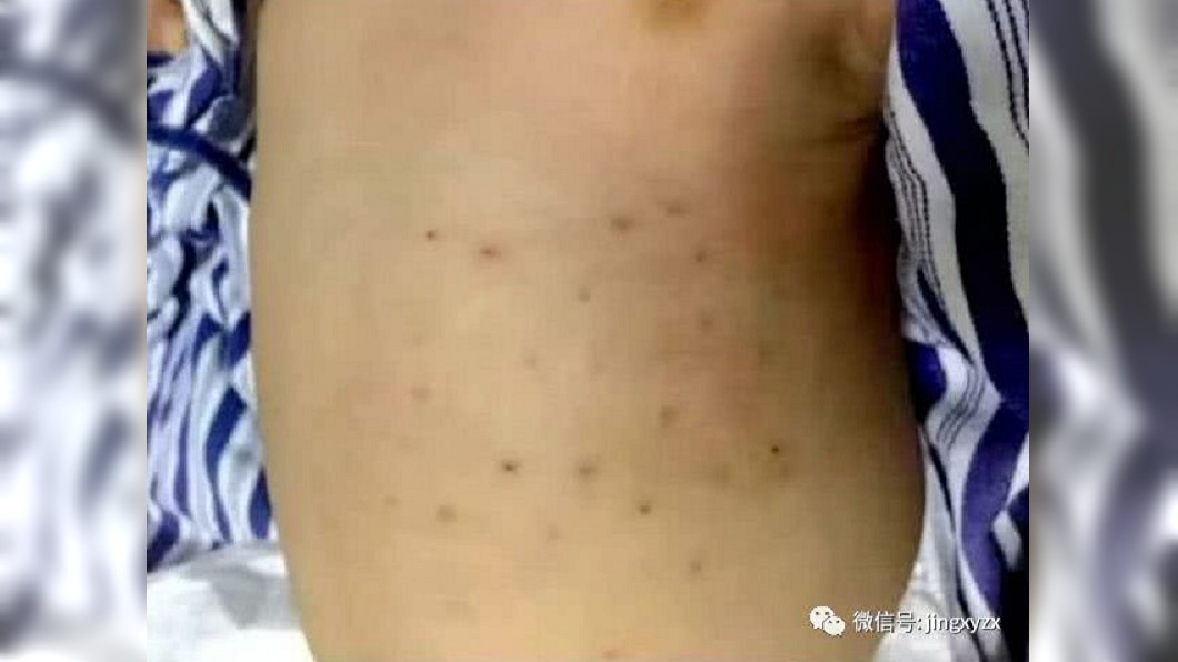 男嬰夜半哭鬧不睡　父母用碎玻璃刺成蜂窩：農村民俗療法