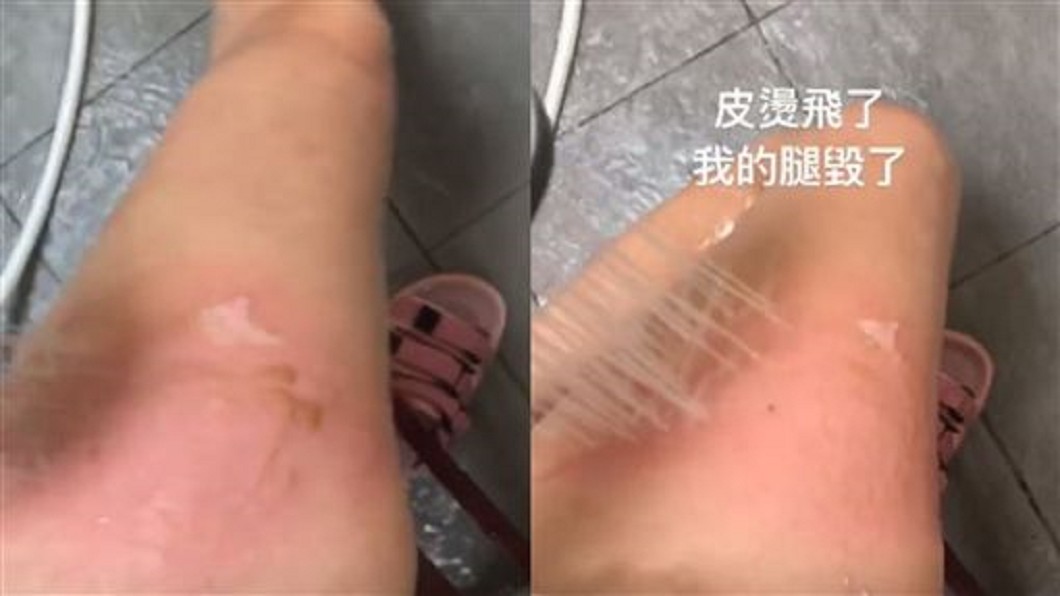 整塊皮掀起!女星燙傷哭喊:我的腿毀了